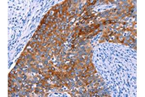 The image on the left is immunohistochemistry of paraffin-embedded Human cervical cancer tissue using ABIN7192345(SGK2 Antibody) at dilution 1/20, on the right is treated with synthetic peptide. (SGK2 antibody)