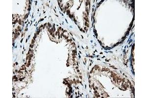 Immunohistochemical staining of paraffin-embedded Carcinoma of liver tissue using anti-PTPRE mouse monoclonal antibody.