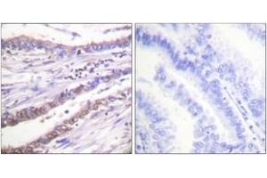 Immunohistochemistry analysis of paraffin-embedded human lung carcinoma tissue, using Cyclin A Antibody.