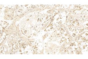 Detection of GAL3 in Human Lung cancer Tissue using Monoclonal Antibody to Galectin 3 (GAL3) (Galectin 3 antibody  (AA 1-250))