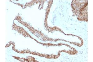 Formalin-fixed, paraffin-embedded human Prostate Carcinoma stained with Catenin, gamma Mouse Monoclonal Antibody (CTNG/1664) (JUP antibody)