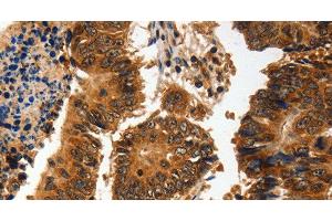 Immunohistochemistry of paraffin-embedded Human colon cancer using ADAP1 Polyclonal Antibody at dilution of 1:60 (ADAP1 antibody)