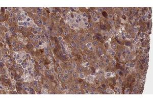 ABIN6277373 at 1/100 staining Human liver cancer tissue by IHC-P. (Connexin 31 antibody  (C-Term))
