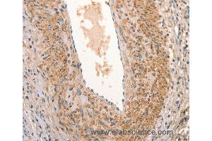 Immunohistochemistry of Human cervical cancer using ARFRP1 Polyclonal Antibody at dilution of 1:25