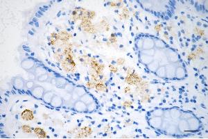 Immunohistochemistry was performed on paraffin-embedded human sigmoid colon carcinoma using JNK1 antibody (ABIN7799457), 1:200). (Recombinant JNK antibody)
