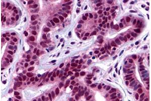 Human Ductal and Lobular Epithelium (formalin-fixed, paraffin-embedded) stained with PTK2 antibody ABIN213433 at 2 ug/ml followed by biotinylated goat anti-rabbit IgG secondary antibody ABIN481713, alkaline phosphatase-streptavidin and chromogen. (FAK antibody  (Internal Region))