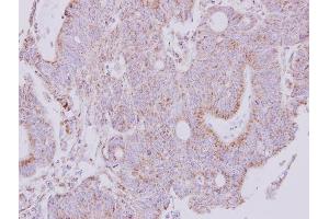 IHC-P Image Immunohistochemical analysis of paraffin-embedded human colon carcinoma, using NDUFS1, antibody at 1:250 dilution. (NDUFS1 antibody  (Center))