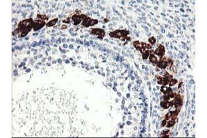 Immunohistochemical staining of paraffin-embedded Adenocarcinoma of Human ovary tissue using anti-PTPN7 mouse monoclonal antibody.