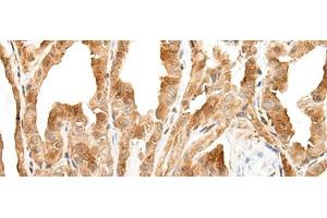 Immunohistochemistry of paraffin-embedded Human thyroid cancer tissue using ZPBP Polyclonal Antibody at dilution of 1:30(x200)