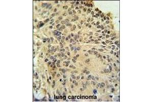 RSPO2 Antibody (C-term) (ABIN651457 and ABIN2840250) immunohistochemistry analysis in formalin fixed and paraffin embedded human lung carcinoma followed by peroxidase conjugation of the secondary antibody and DAB staining.
