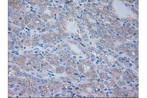 Immunohistochemical staining of paraffin-embedded Carcinoma of thyroid tissue using anti-NRBP1mouse monoclonal antibody. (NRBP1 antibody)