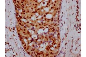 IHC image of ABIN7127442 diluted at 1:100 and staining in paraffin-embedded human breast cancer performed on a Leica BondTM system. (Recombinant Cyclin E1 antibody)