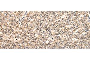 Immunohistochemistry of paraffin-embedded Human liver cancer tissue using VPS33B Polyclonal Antibody at dilution 1:40 (VPS33B antibody)