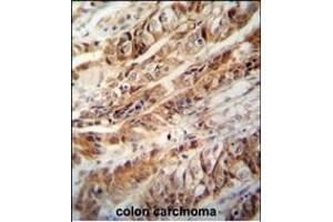 ZC3H15 antibody (C-term) (ABIN654819 and ABIN2844492) immunohistochemistry analysis in formalin fixed and paraffin embedded human colon carcinoma followed by peroxidase conjugation of the secondary antibody and DAB staining.