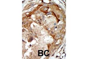 Formalin-fixed and paraffin-embedded human cancer tissue reacted with the primary antibody, which was peroxidase-conjugated to the secondary antibody, followed by AEC staining. (SGK3 antibody  (AA 108-139))