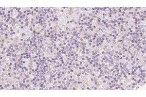 ABIN6273094 at 1/100 staining Human lymph cancer tissue by IHC-P.
