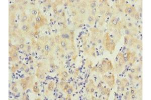 Immunohistochemistry of paraffin-embedded human liver cancer using ABIN7174120 at dilution of 1:100 (PTPN7 antibody  (AA 1-190))
