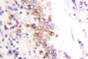 Immunohistochemical analysis of paraffin-embedded human lung cancer tissue using PIAS1 polyclonal antibody .