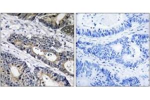 Immunohistochemistry analysis of paraffin-embedded human colon carcinoma, using GLB1L3 Antibody.