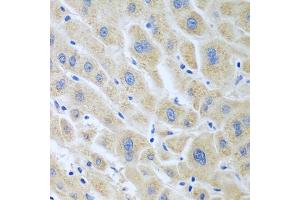 Immunohistochemistry of paraffin-embedded human liver cancer using BLVRB antibody. (BLVRB antibody)