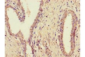 Immunohistochemistry of paraffin-embedded human prostate cancer using ABIN7164562 at dilution of 1:100 (ZDHHC1 antibody  (AA 283-389))