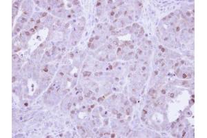 IHC-P Image Immunohistochemical analysis of paraffin-embedded NCIN87 Xenograft, using cyclin A , antibody at 1:500 dilution. (Cyclin A antibody)