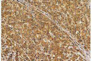 ABIN6264901 and ABIN6272886 at 1/100 staining Human breast cancer by IHC-P. (S100A14 antibody  (N-Term))