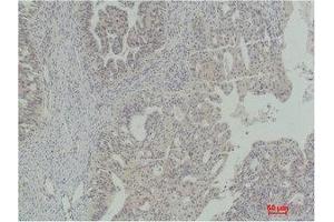 Immunohistochemistry (IHC) analysis of paraffin-embedded Human Ovarian Carcinoma using Stat5a Polyclonal Antibody. (STAT5A antibody)