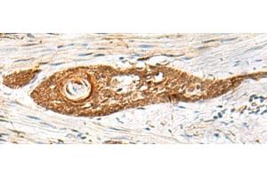 Immunohistochemistry of paraffin-embedded Human esophagus cancer tissue using GPSM1 Polyclonal Antibody at dilution of 1:85(x200) (GPSM1 antibody)