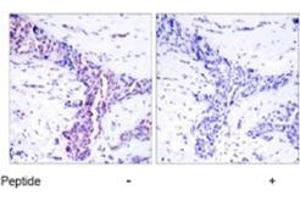 Immunohistochemical analysis of paraffin-embedded human breast carcinoma tissue using ATF2 polyclonal antibody  .