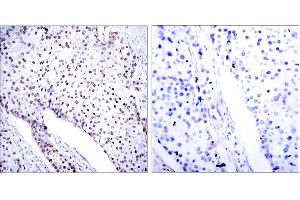 Immunohistochemistry analysis of paraffin-embedded human breast carcinoma tissue, using STAT3 (Ab-705) Antibody. (STAT3 antibody)