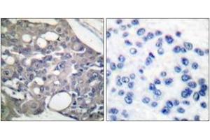 Immunohistochemistry analysis of paraffin-embedded human breast carcinoma, using SHP-1 (Phospho-Tyr536) Antibody. (SHP1 antibody  (pTyr536))