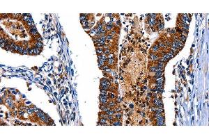 Immunohistochemistry of paraffin-embedded Human colon cancer tissue using ITGA7 Polyclonal Antibody at dilution 1:35 (ITGA7 antibody)