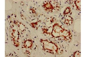 IHC image of ABIN7161970 diluted at 1:800 and staining in paraffin-embedded human breast cancer performed on a Leica BondTM system. (NOL3 antibody  (AA 1-208))