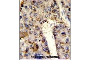 Formalin-fixed and paraffin-embedded human hepatocarcinoma reacted with HNRPL Antibody (Center), which was peroxidase-conjugated to the secondary antibody, followed by DAB staining.