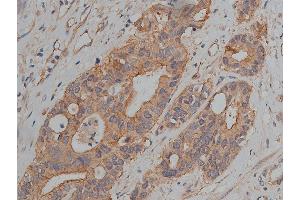 ABIN6269036 at 1/200 staining human colon cancer tissue sections by IHC-P. (JUP antibody  (C-Term))