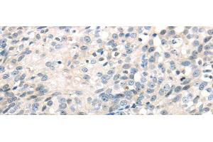 Immunohistochemistry of paraffin-embedded Human ovarian cancer using IQGAP2 Polyclonal Antibody at dilution of 1/40 (IQGAP2 antibody)