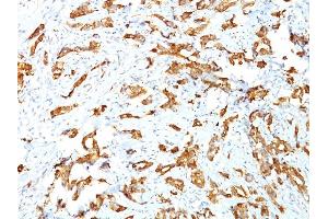 Formalin-fixed, paraffin-embedded human Breast Carcinoma stained with HSP27 Monoclonal Antibody (G3. (HSP27 antibody)