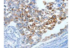 The image on the left is immunohistochemistry of paraffin-embedded Human breast cancer tissue using ABIN7130299(MUC15 Antibody) at dilution 1/25, on the right is treated with fusion protein. (MUC15 antibody)
