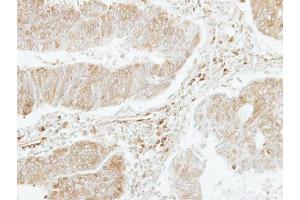 IHC-P Image Immunohistochemical analysis of paraffin-embedded human colon carcinoma, using PF4V1, antibody at 1:250 dilution. (PF4V1 antibody  (C-Term))