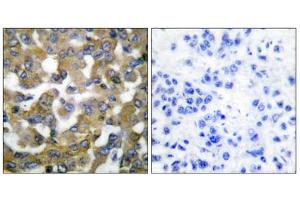Immunohistochemical analysis of paraffin-embedded human breast carcinoma tissue using Keratin 19 antibody (ABIN5976439). (Cytokeratin 19 antibody  (Internal Region))