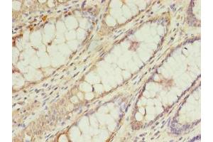 Immunohistochemistry of paraffin-embedded human colon cancer using ABIN7173516 at dilution of 1:100 (TRNAU1AP antibody  (AA 33-156))