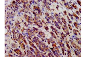 IHC image of ABIN7146245 diluted at 1:600 and staining in paraffin-embedded human pancreatic cancer performed on a Leica BondTM system.