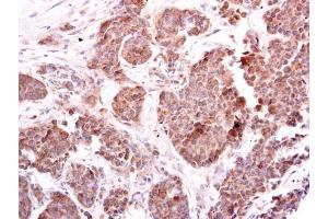 IHC-P Image EIF4E2 antibody [N1C3] detects EIF4E2 protein at cytoplasm on human breast carcinoma by immunohistochemical analysis.