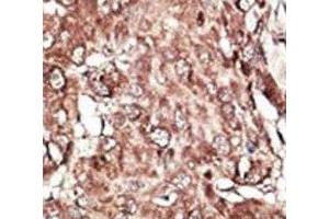 IHC analysis of FFPE human hepatocarcinoma stained with the PRMT7 antibody (PRMT7 antibody  (AA 1-30))