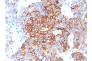 Formalin-fixed, paraffin-embedded human bladder carcinoma stained with Tubulin beta 3 Mouse Monoclonal Antibody (TUBB3/3732). (TUBB3 antibody  (AA 437-450))