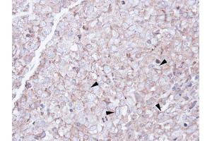 IHC-P Image Immunohistochemical analysis of paraffin-embedded CL1-0 xenograft, using SCARA3, antibody at 1:100 dilution. (SCARA3 antibody)