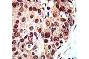 IHC analysis of FFPE human breast carcinoma tissue stained with the PRMT3 antibody