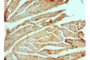 Immunohistochemistry of paraffin-embedded human prostate cancer using ABIN7151465 at dilution of 1:100