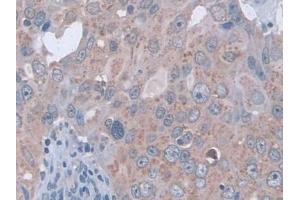 DAB staining on IHC-P; Samples: Human Breast cancer Tissue (D2HGDH antibody  (AA 56-232))